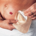 Starostlivosť o pokožku v okolí kolostómie