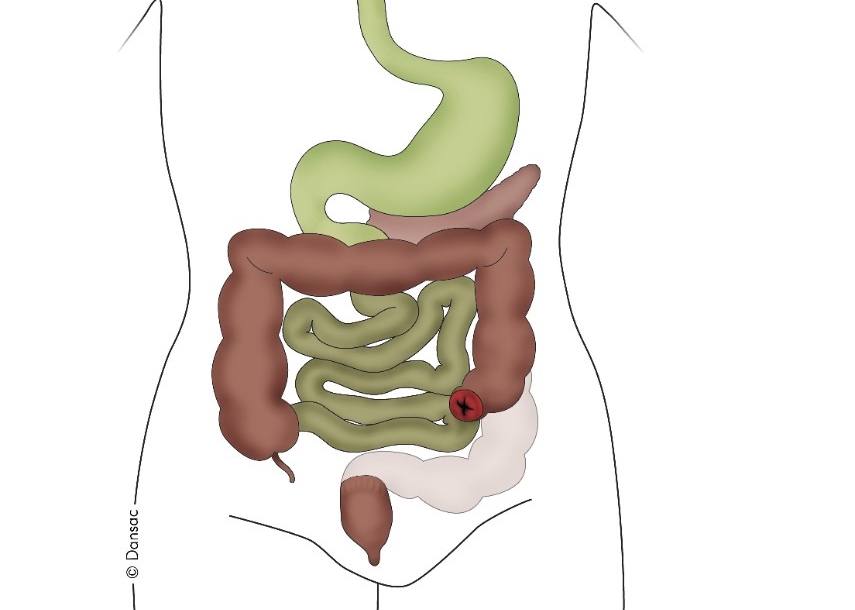 Kolostómia - všeobecné informácie