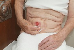 Osušte čistou a suchou gázou. Je veľmi dôležité, aby bolo okolie stómie pred nasadením vrecka úplne suché.