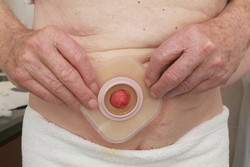 Umiestnite podložku otvorom na vašu stómiu. Podložku prstami pritlačte od stredu stómie smerom k okrajom.