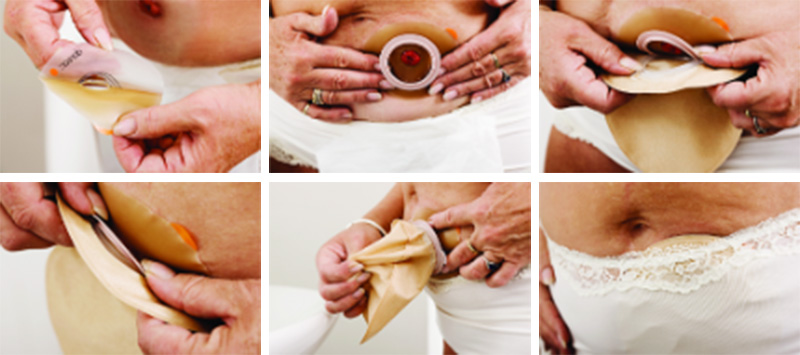 Aplikácia podložky a vrecka