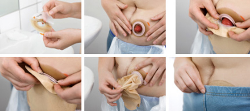 Aplikácia podložky a vrecka