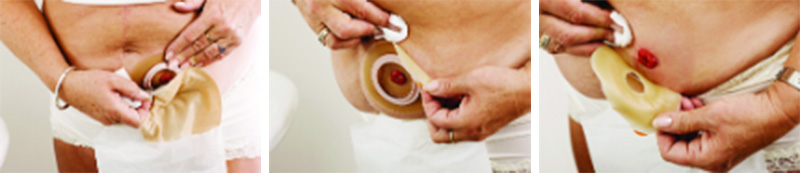 Odstránenie vrecka a podložky