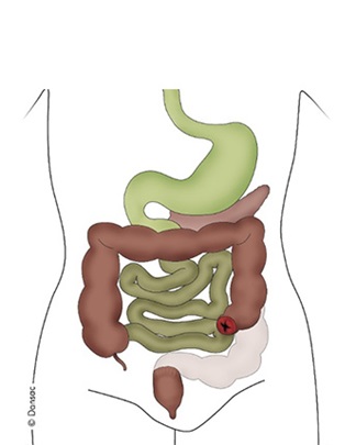 Kolostómia - je vývod na hrubom čreva a ide o najčastejší typ stómie.